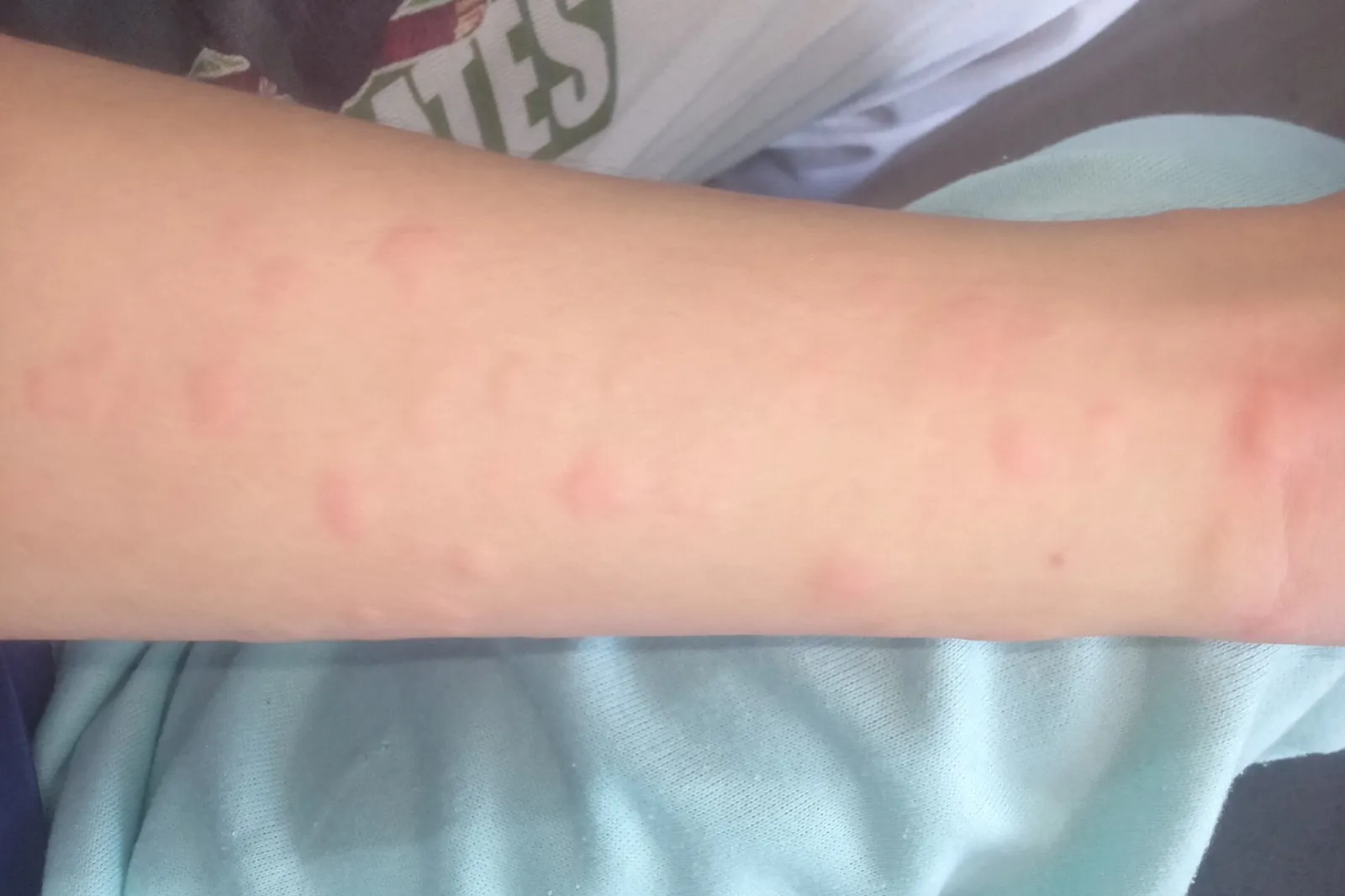 Bed bug bite welts in a line, representing bed bug treatment in Mobile, AL